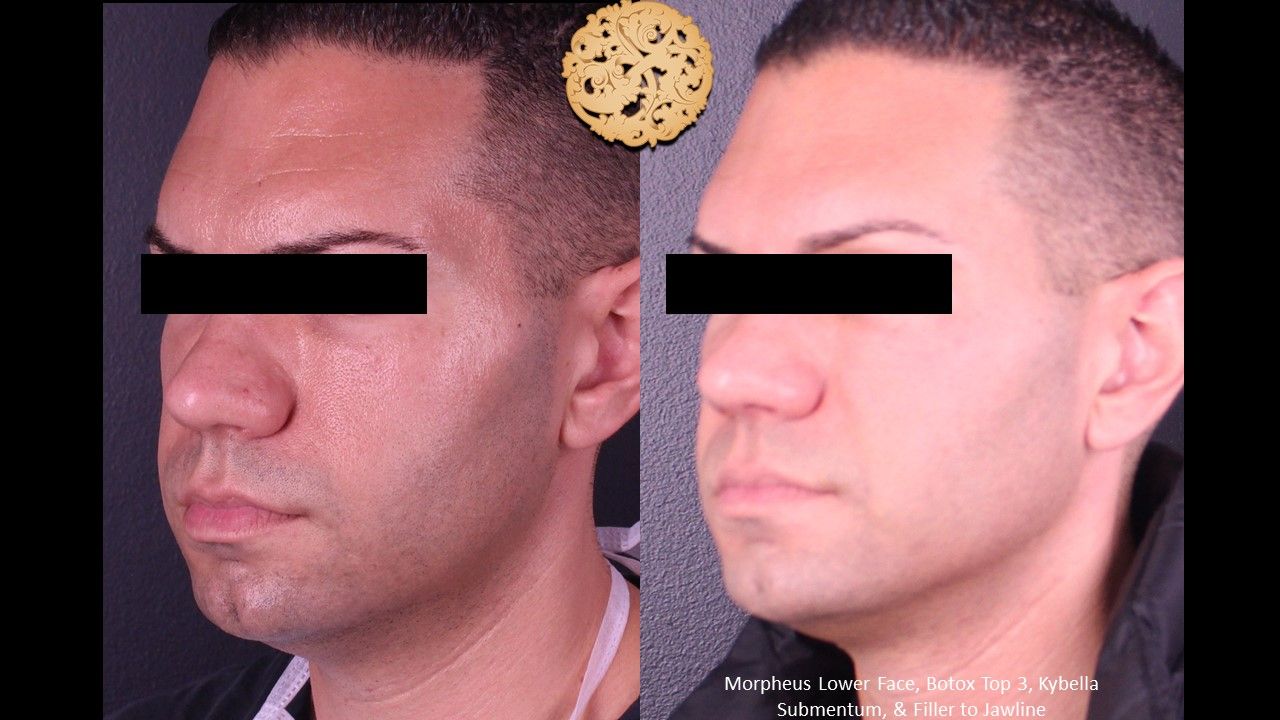 Morpheus8 Face Before & After