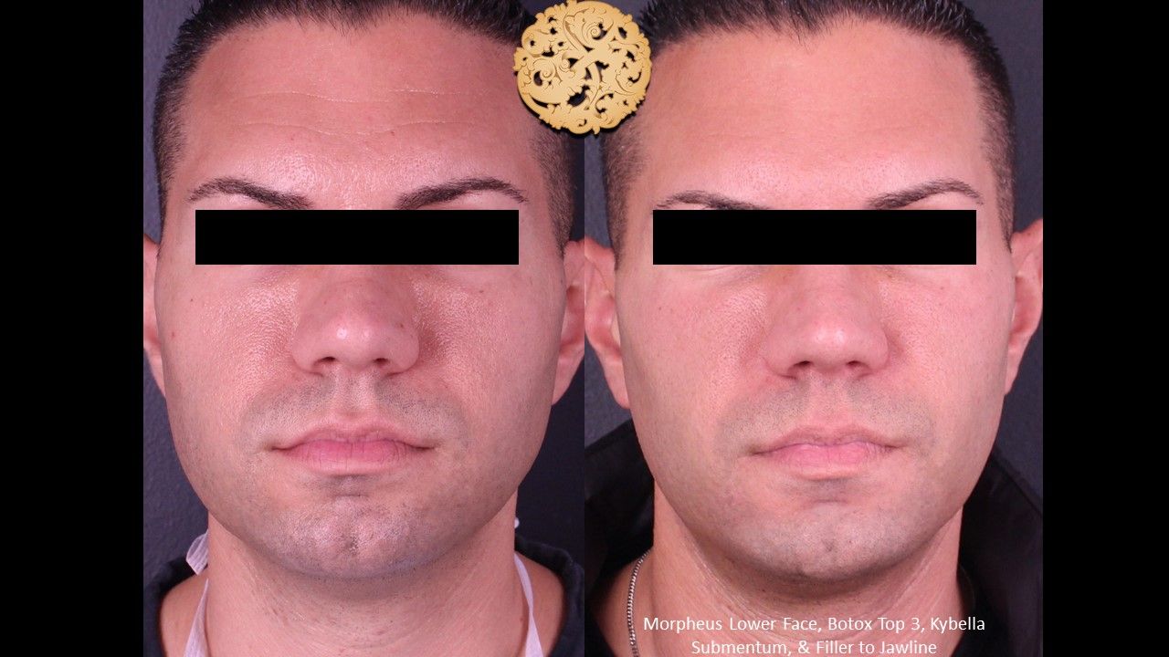 Morpheus8 Face Before & After
