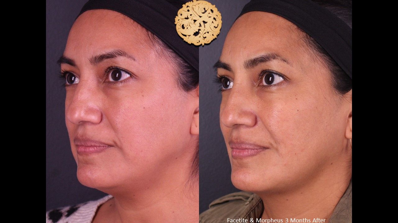 Morpheus8 Face Before & After