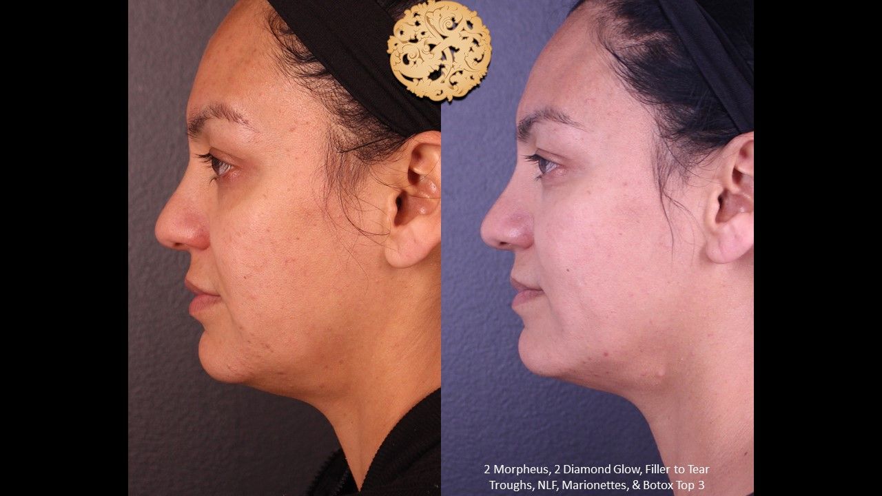 Morpheus8 Face Before & After