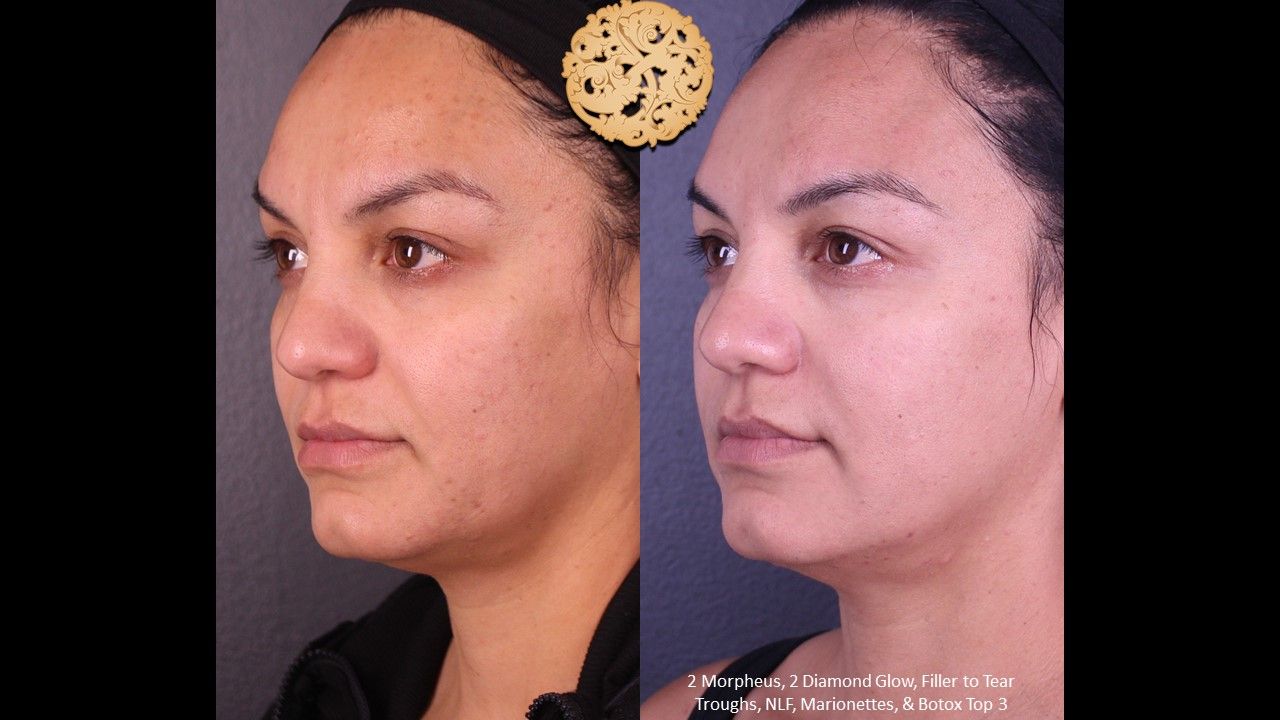 Morpheus8 Face Before & After