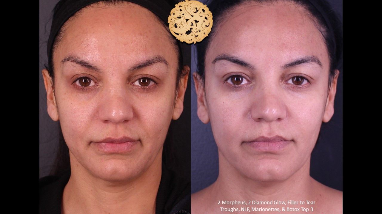 Morpheus8 Face Before & After