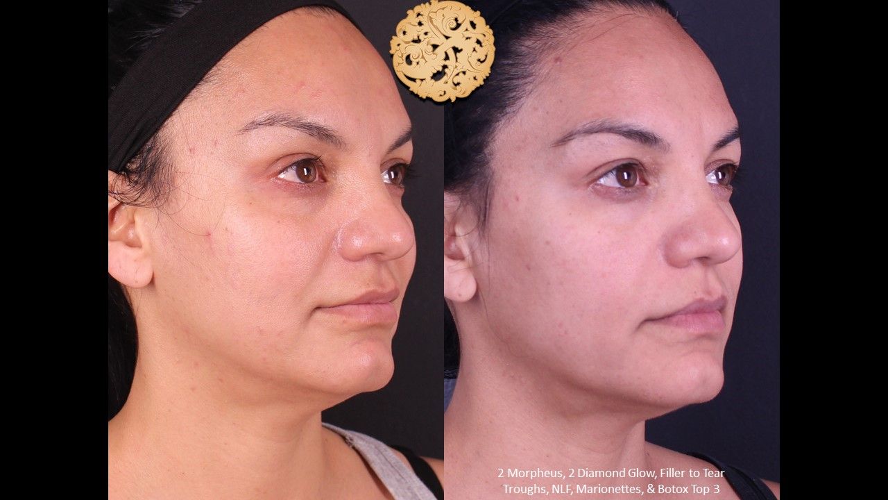 Morpheus8 Face Before & After