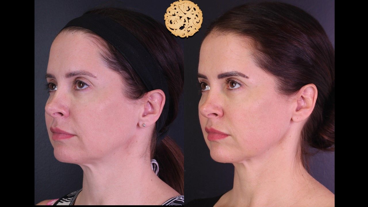 Morpheus8 Face Before & After