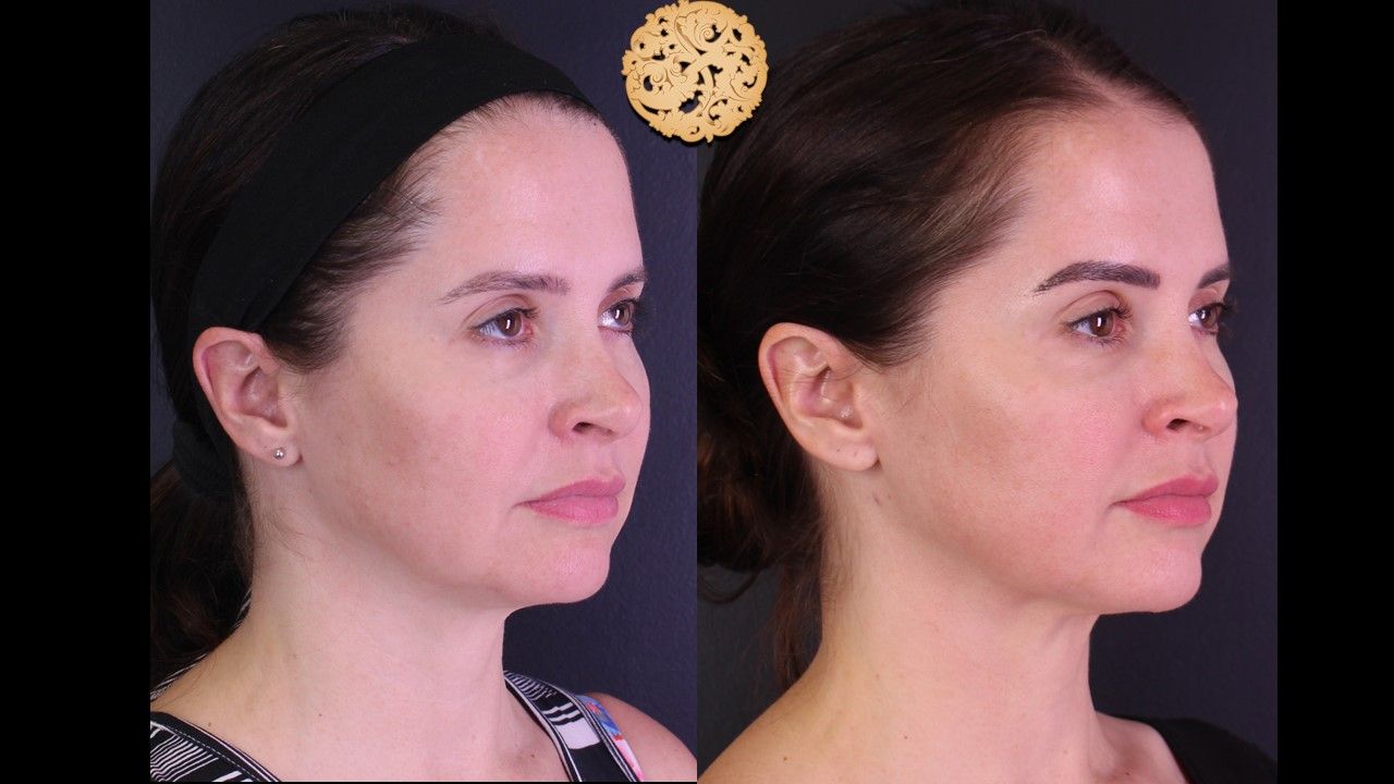 Morpheus8 Face Before & After