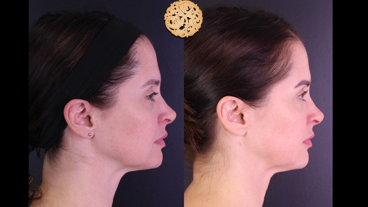 Morpheus8 Face Before & After