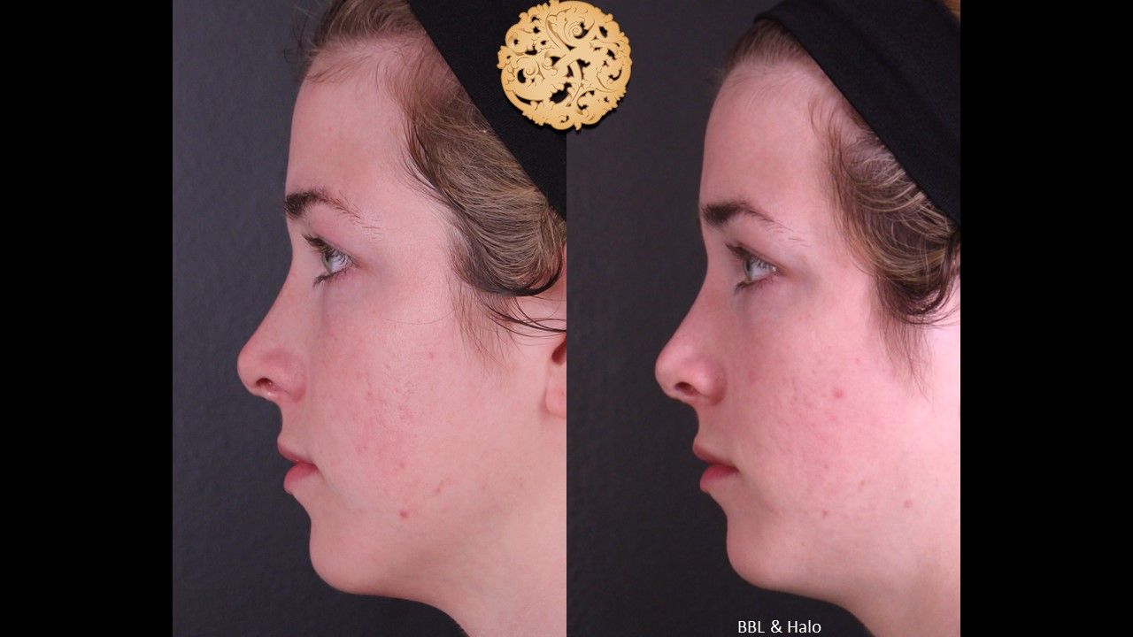 BBL Laser Pigmentation Before & After