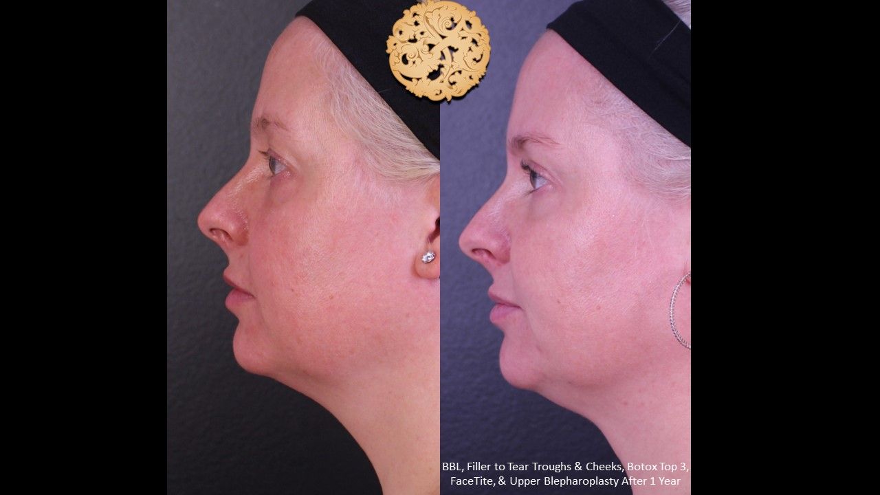 BBL Laser Pigmentation Before & After