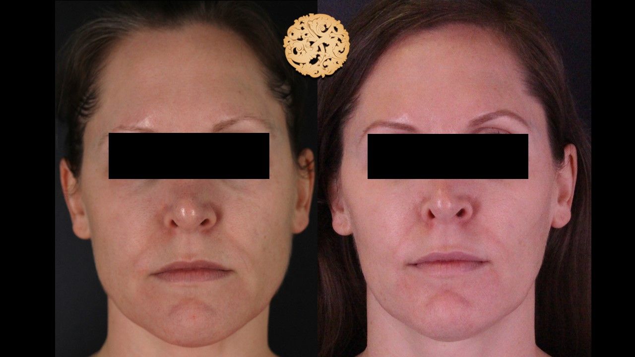 Bbl Laser Pigmentation Before & After