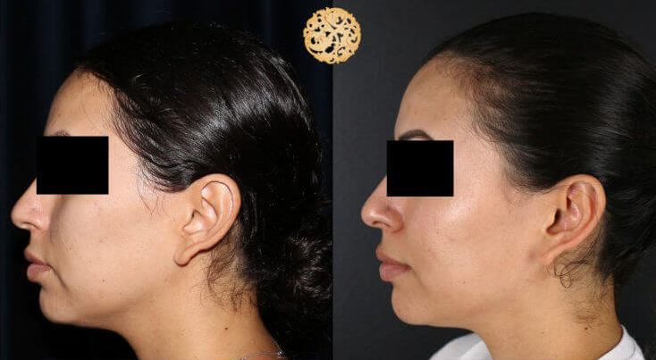BBL Laser Pigmentation Before & After