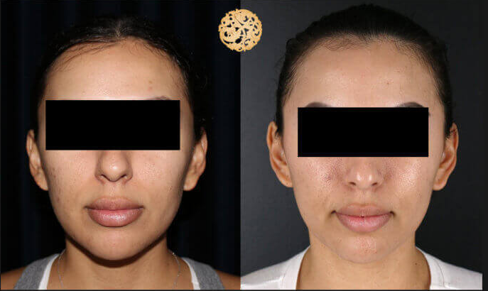 Bbl Laser Pigmentation Before & After