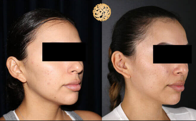 Bbl Laser Pigmentation Before & After