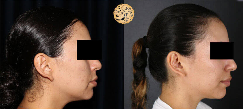 Bbl Laser Pigmentation Before & After