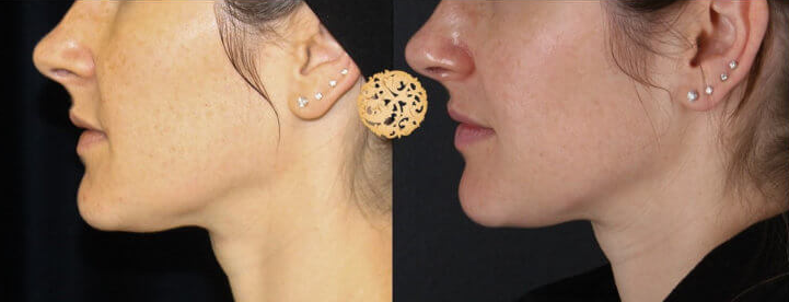 BBL Laser Pigmentation Before & After