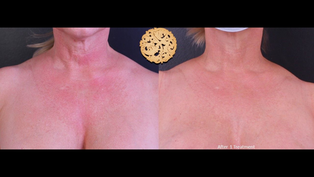 BBL Laser Pigmentation Before & After