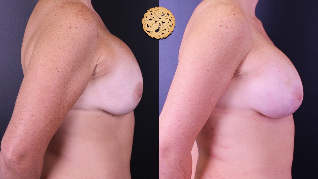 Fat Transfer To Breasts Before & After