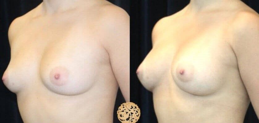 Fat Transfer To Breasts Before & After