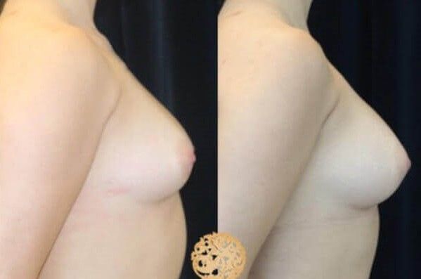 Fat Transfer To Breasts Before & After
