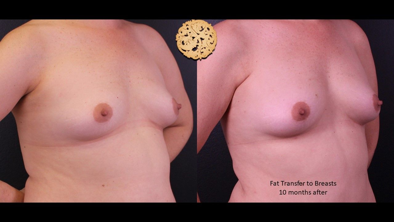 Fat Transfer To Breasts Before & After