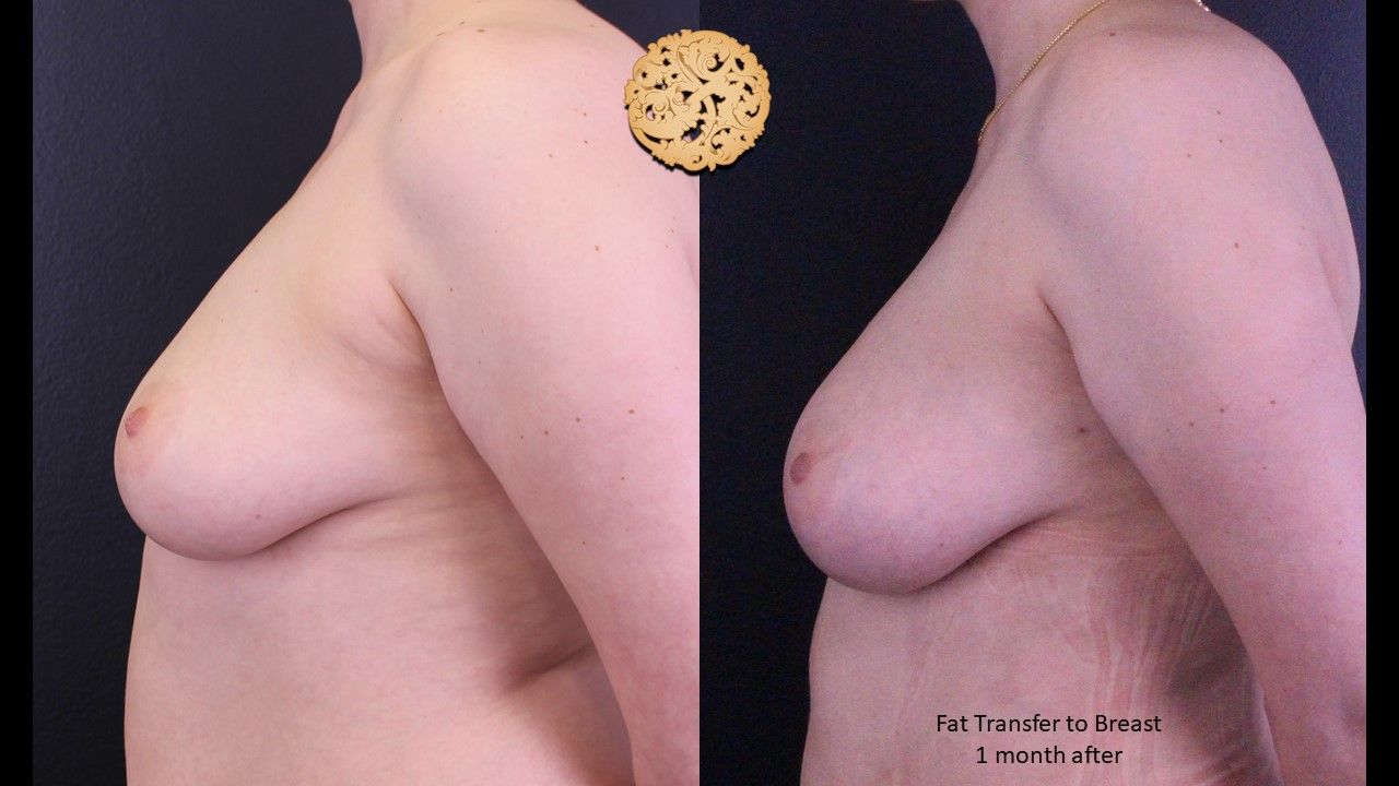 Fat Transfer To Breasts Before & After