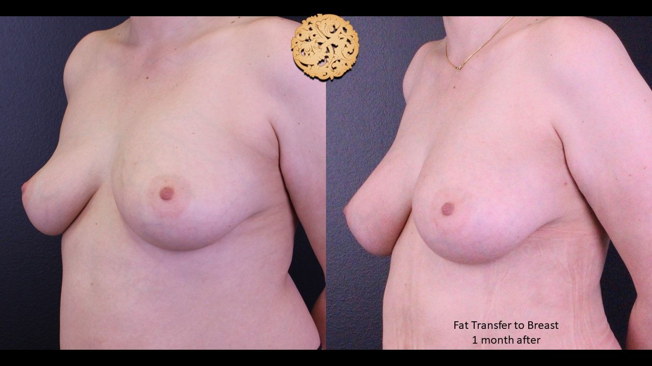Fat Transfer To Breasts Before & After