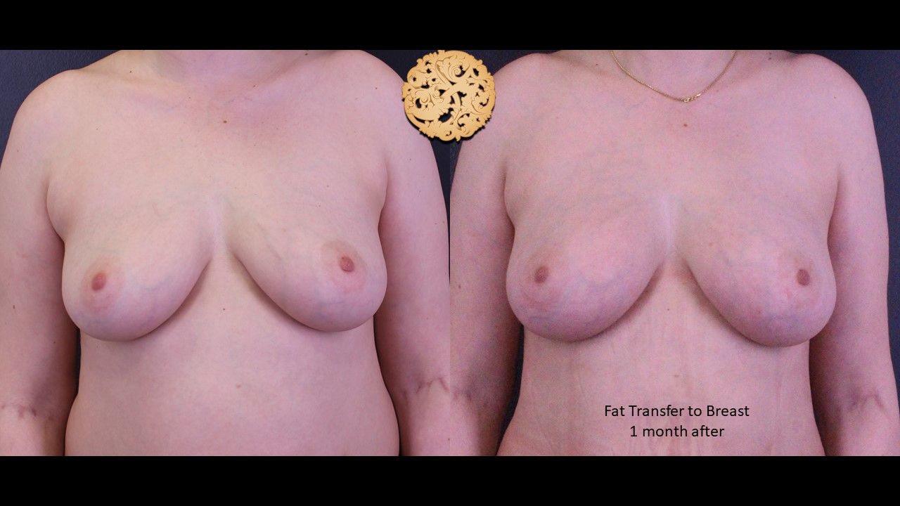 Fat Transfer To Breasts Before & After