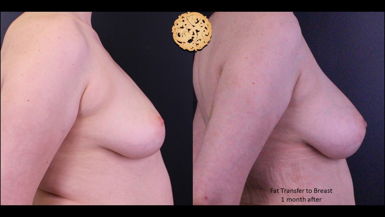 Fat Transfer To Breasts Before & After