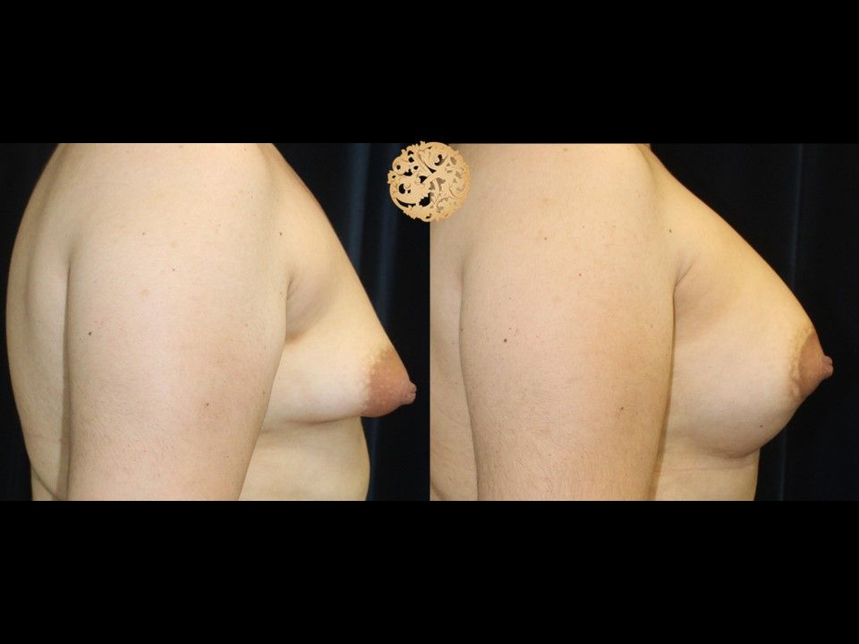Fat Transfer To Breasts Before & After