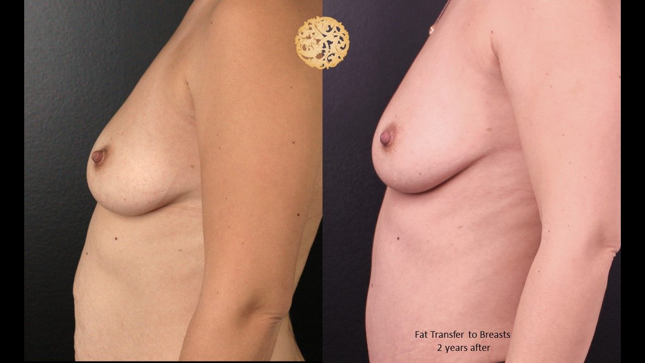 Fat Transfer To Breasts Before & After