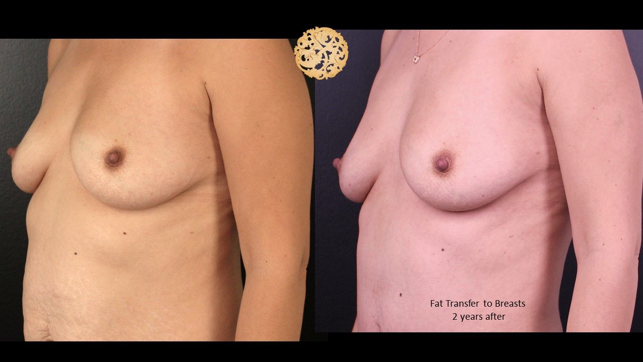 Fat Transfer To Breasts Before & After