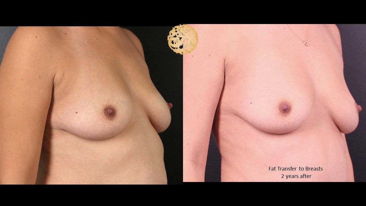 Fat Transfer To Breasts Before & After
