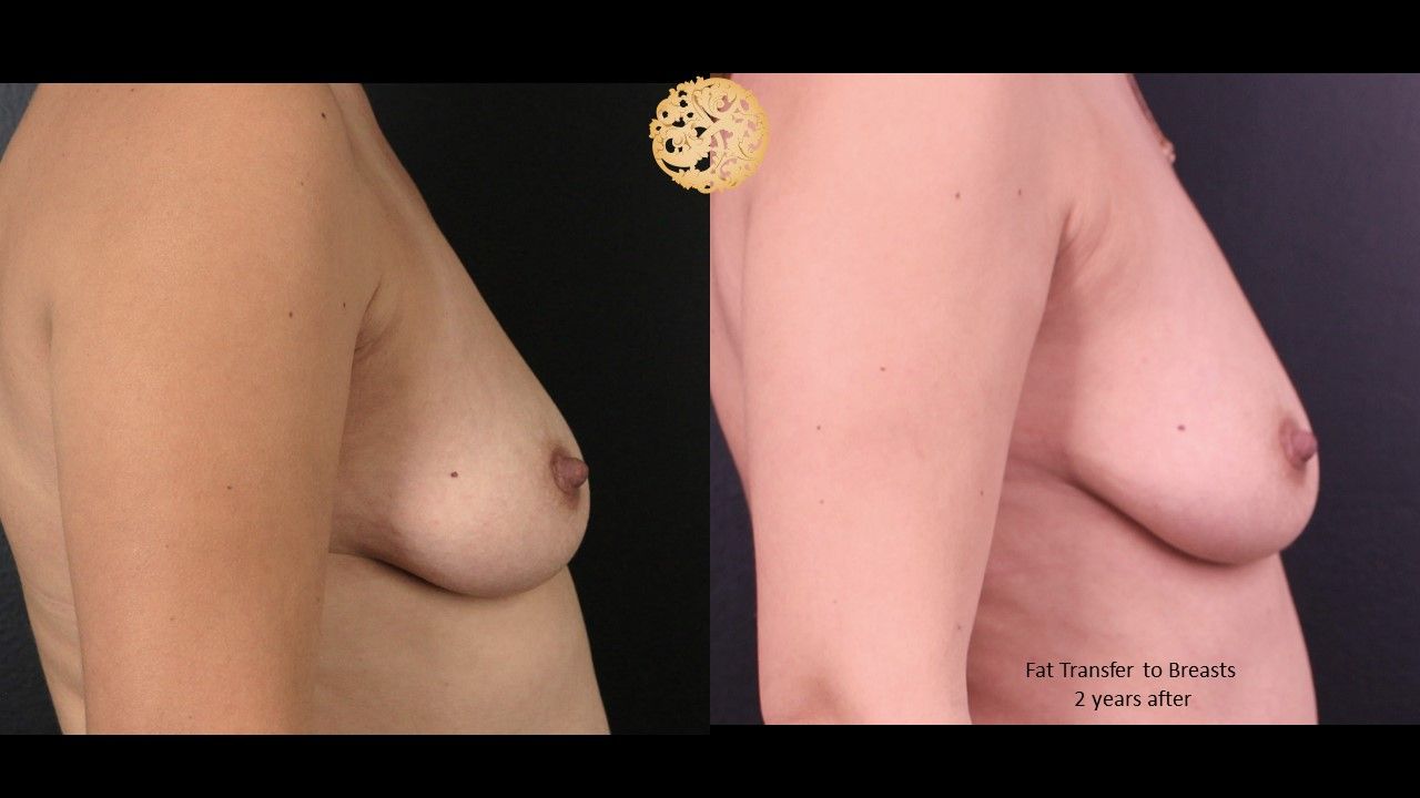 Fat Transfer To Breasts Before & After