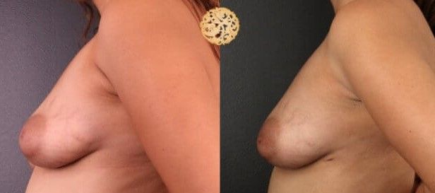 Fat Transfer To Breasts Before & After