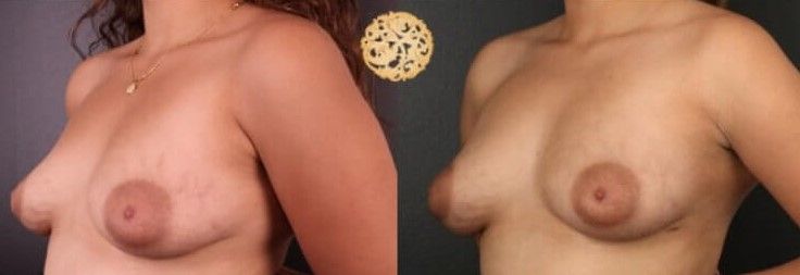 Fat Transfer To Breasts Before & After