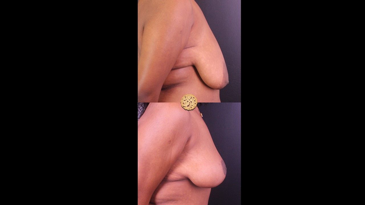 Fat Transfer To Breasts Before & After