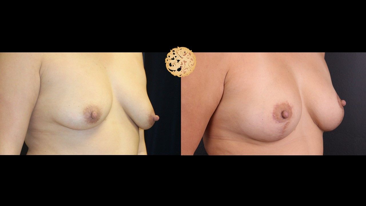 Fat Transfer To Breasts Before & After