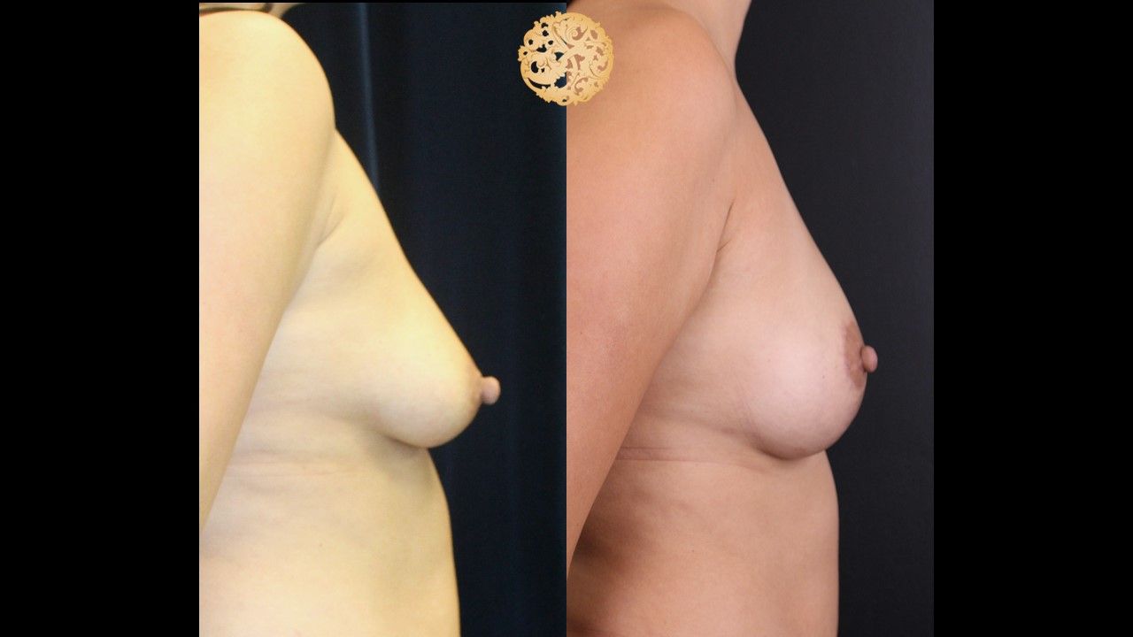 Fat Transfer To Breasts Before & After