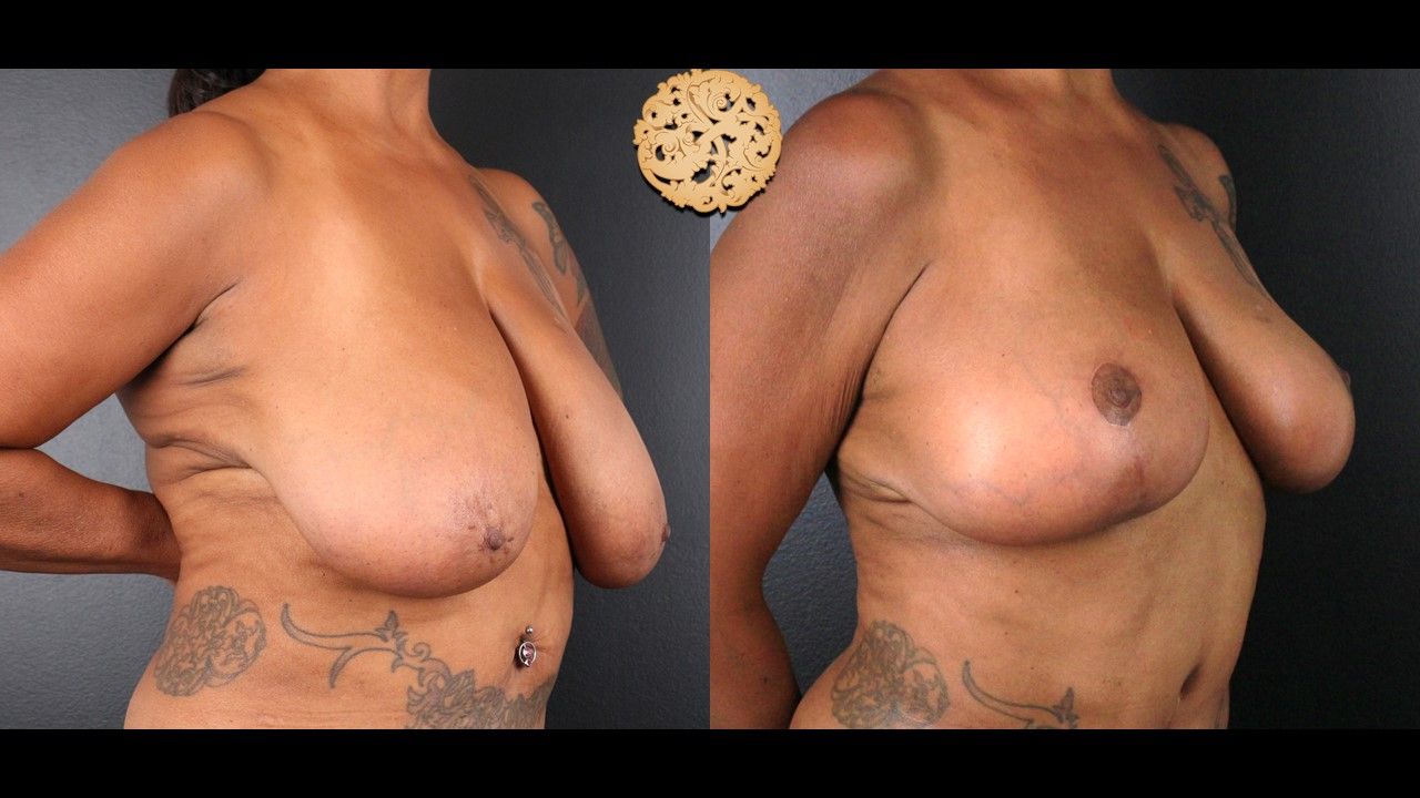 Fat Transfer To Breasts Before & After