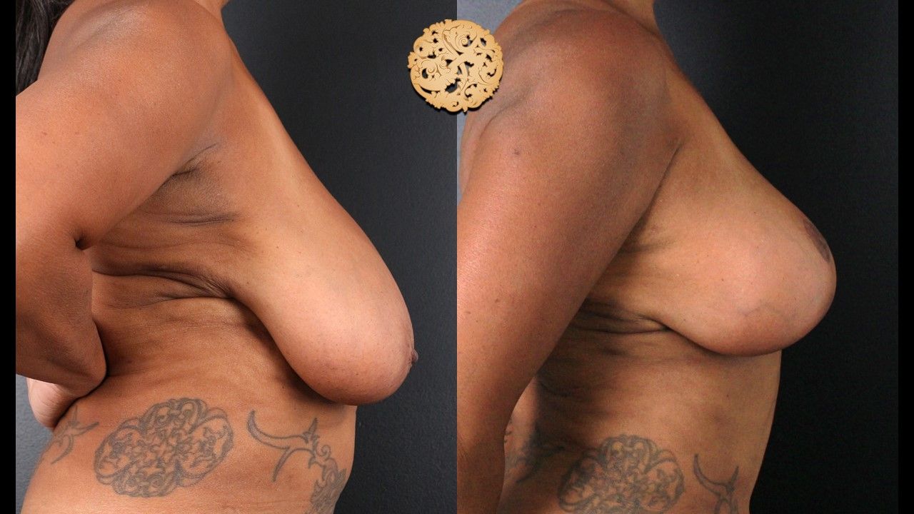 Fat Transfer To Breasts Before & After