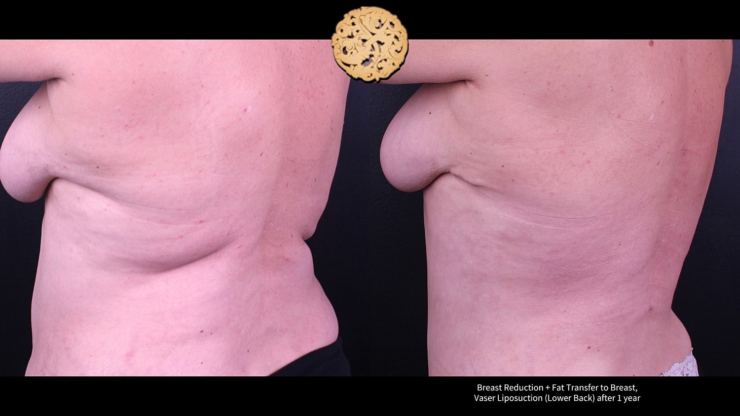 Fat Transfer To Breasts Before & After