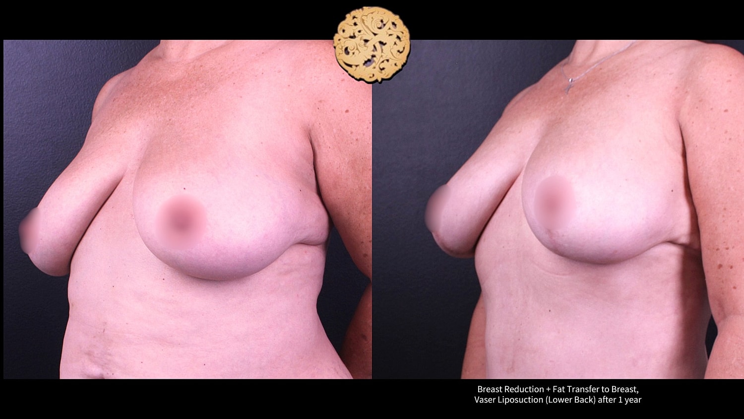 Fat Transfer To Breasts Before & After