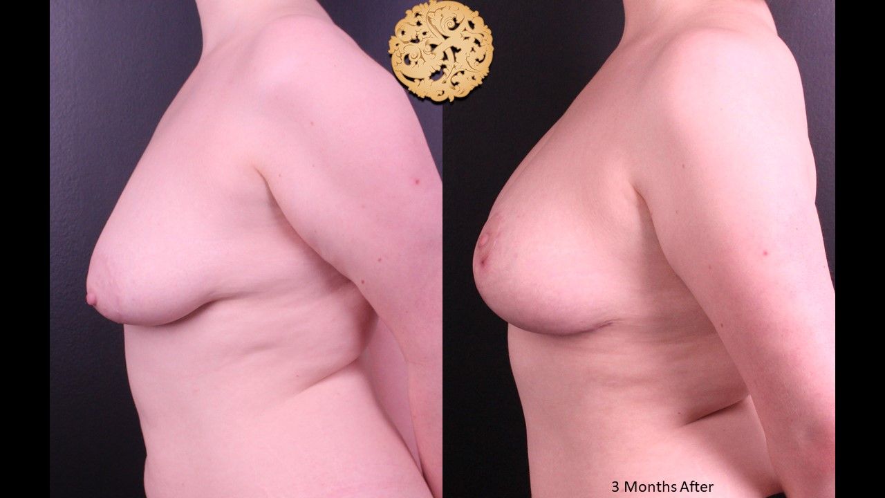 Fat Transfer To Breasts Before & After