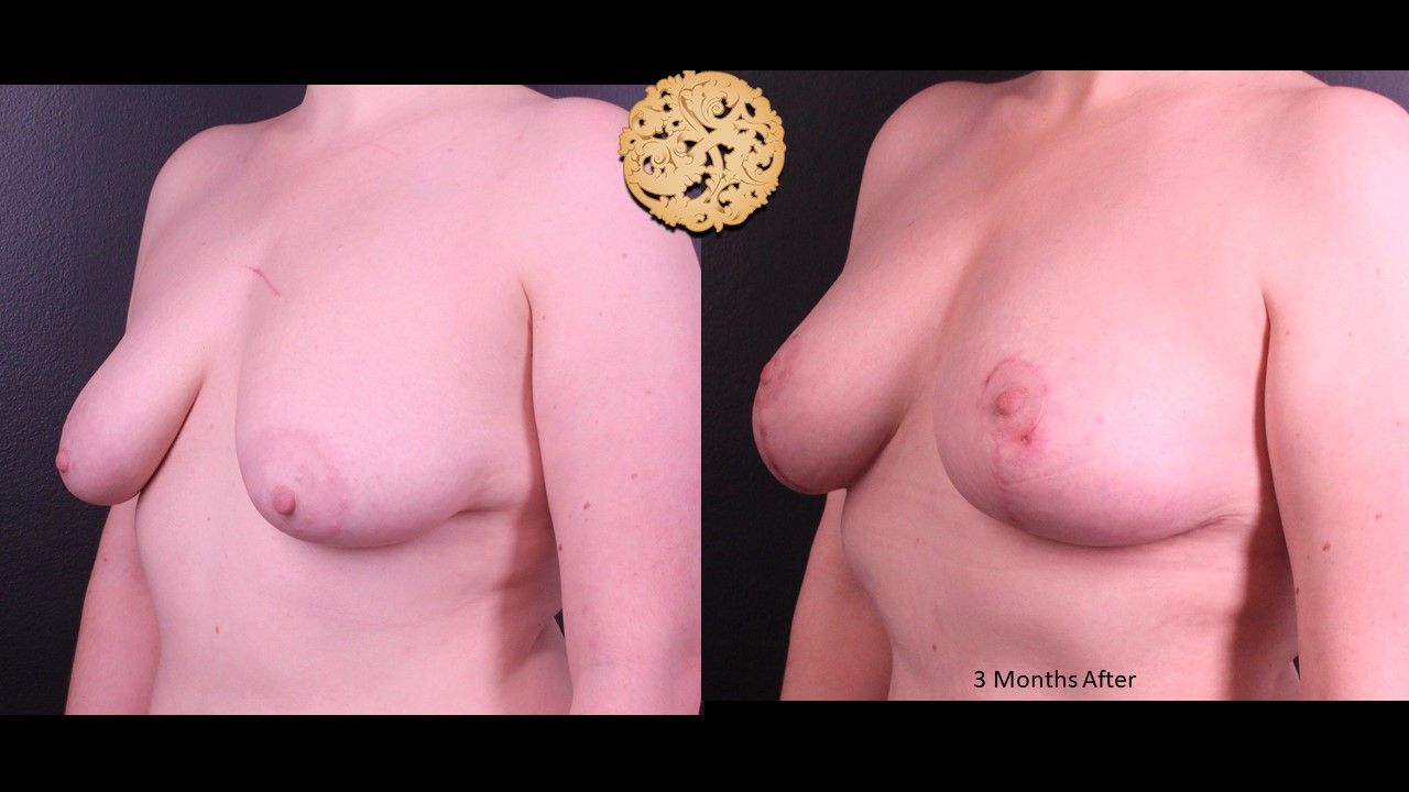Fat Transfer To Breasts Before & After