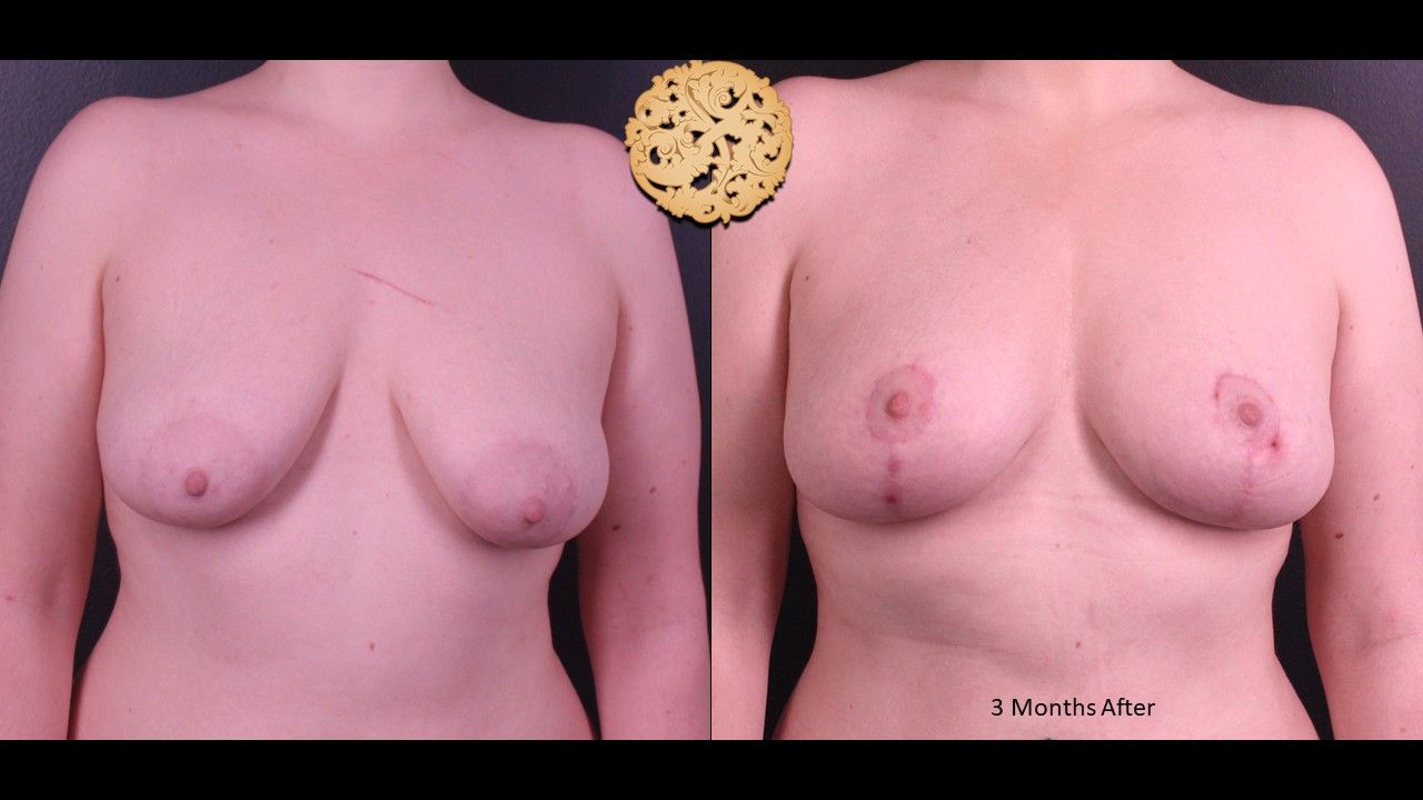 Fat Transfer To Breasts Before & After