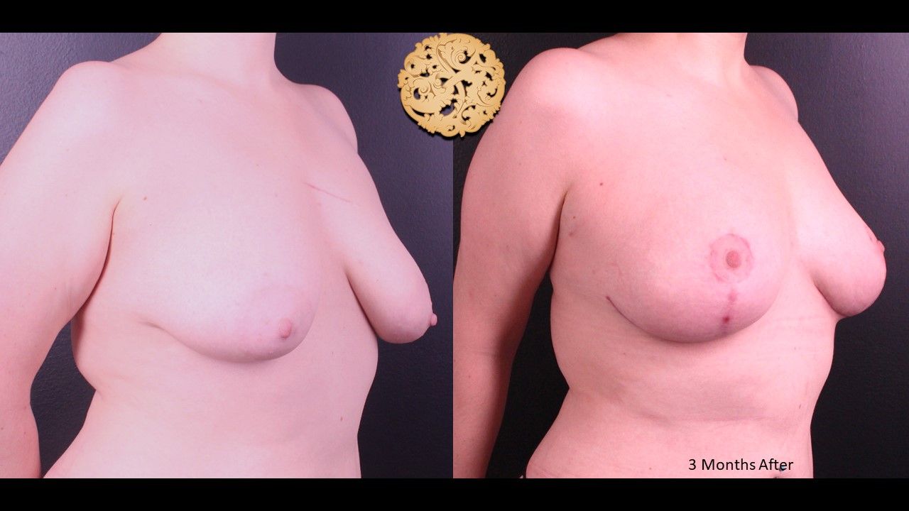 Fat Transfer To Breasts Before & After
