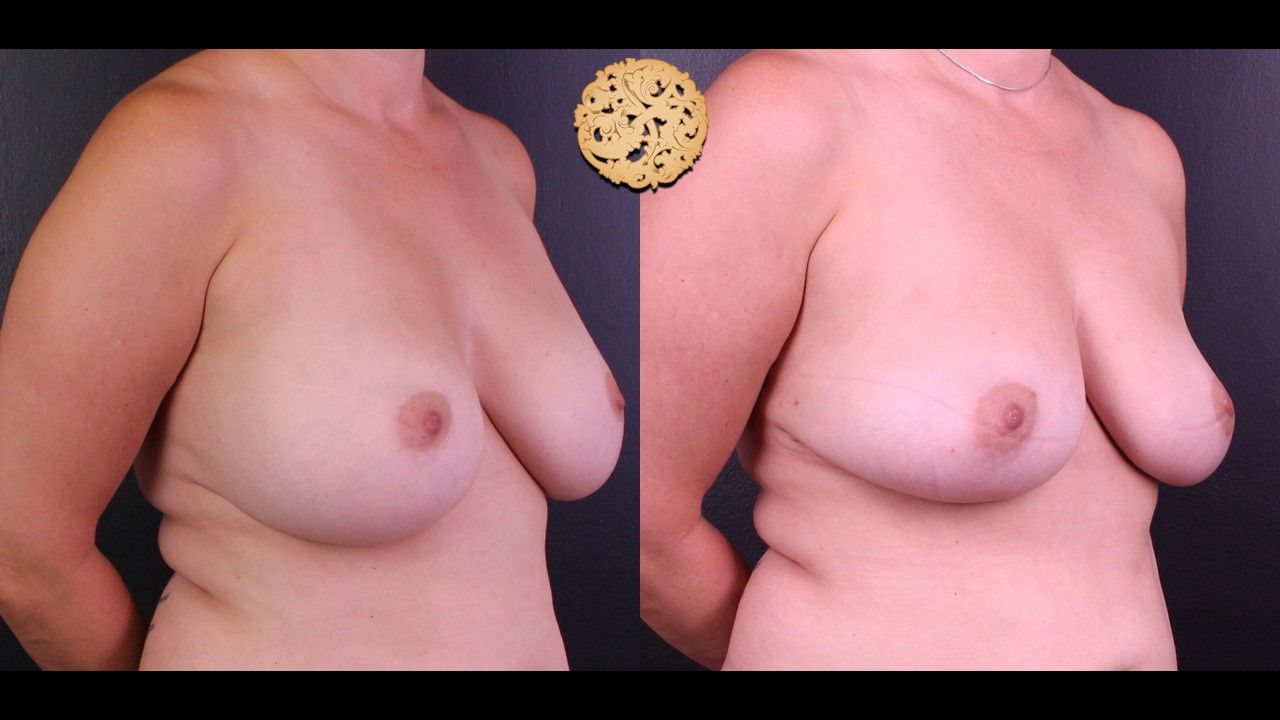 Fat Transfer To Breasts Before & After