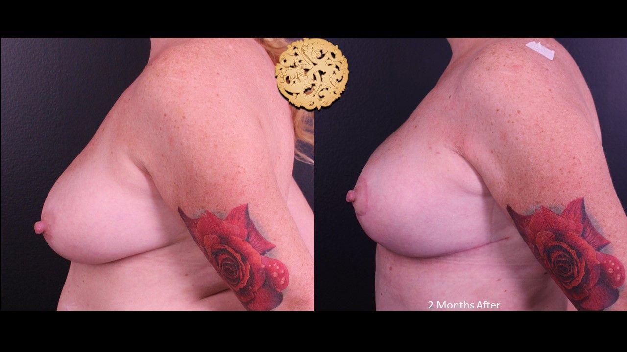 Fat Transfer To Breasts Before & After