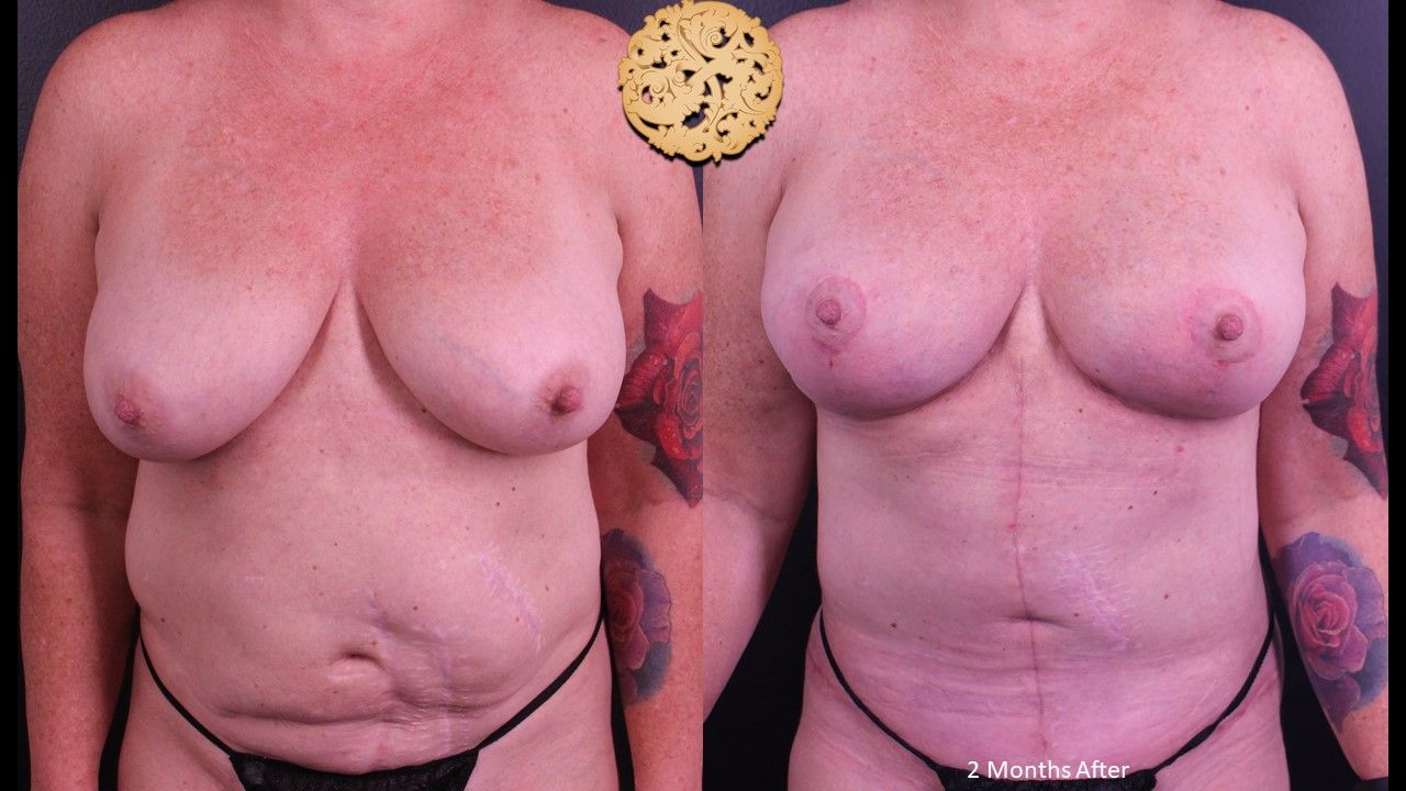 Fat Transfer To Breasts Before & After