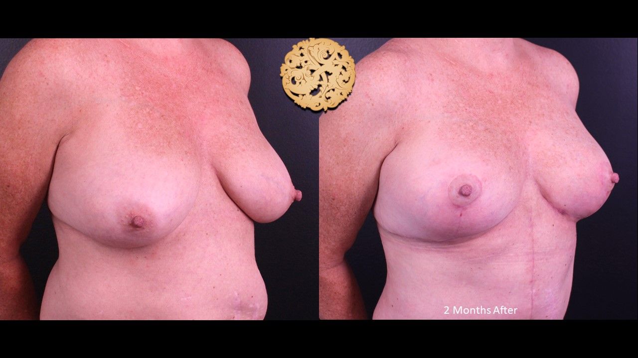 Fat Transfer To Breasts Before & After