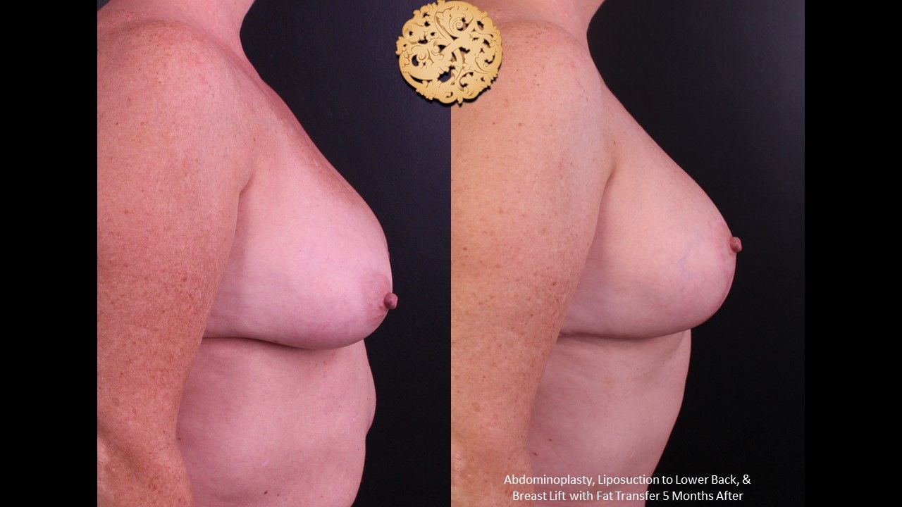 Fat Transfer To Breasts Before & After